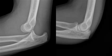 Trauma X-ray - Upper limb gallery 1 - Elbow - Dislocation