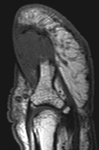 Glomus Tumor Mri