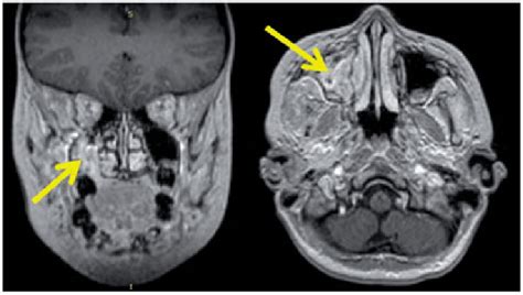 Maxillary Sinus Polyp Mri