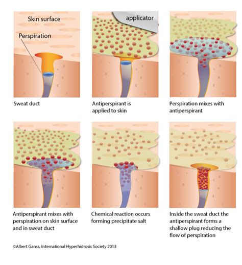 Antiperspirant Basics - International Hyperhidrosis Society | Official Site