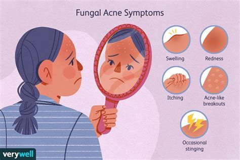 Fungal Acne: How to Identify and Treat It