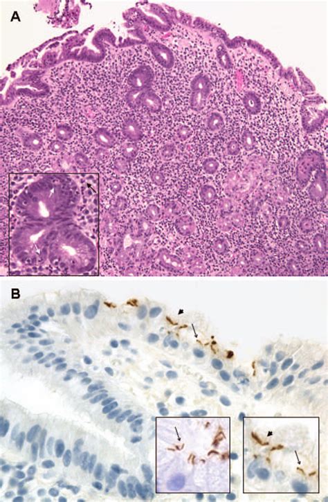 Helicobacter pylori–associated atrophic gastritis. A, Chronic active ...