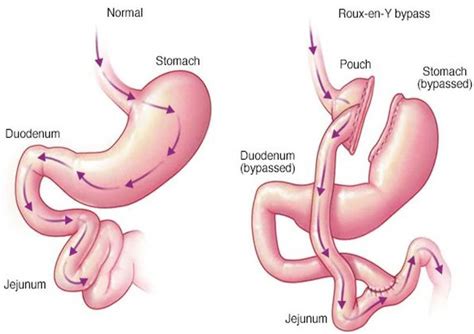 Roux En Y Gastric Bypass Surgery Perth | Tailored Solutions