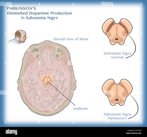 Illustration showing degeneration of dopaminergic neurons in the substantia nigra of the ...