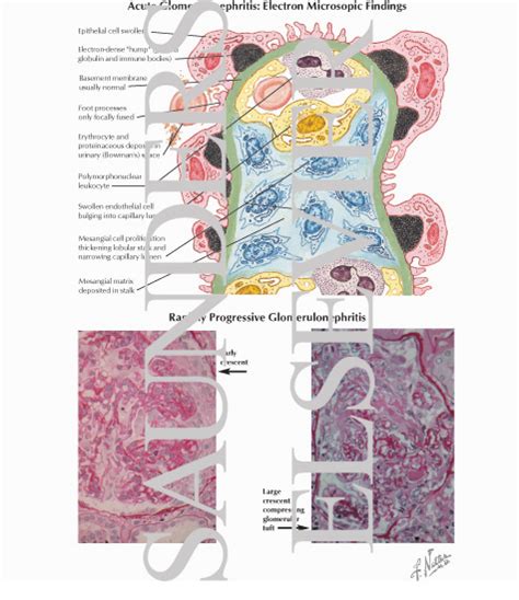 Acute Glomerulonephritis