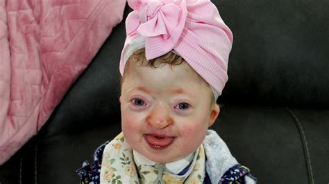 Josie's Joyful Life (One Of the World's Rarest Syndromes) | Josie is ...