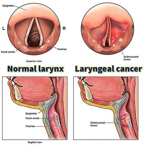 Common Types of Head & Neck Cancer | ENT Doctor Cape Town | Dr Shabeer Ebrahim