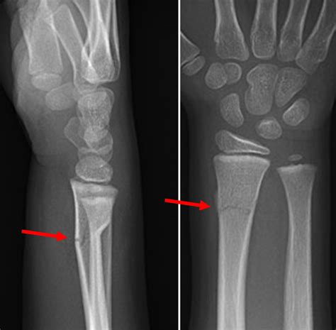 Tibial Metaphysis Fracture