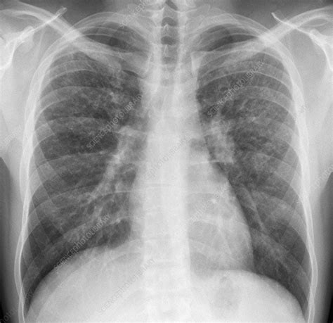 Pulmonary sarcoidosis, X-ray - Stock Image - C021/2961 - Science Photo Library