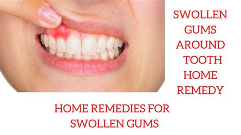 Swollen gums around tooth home remedy | Home Remedies for Swollen Gums - YouTube