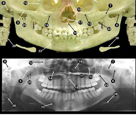 Dentistry lectures for MFDS/MJDF/NBDE/ORE: Anatomical Landmarks Of ...