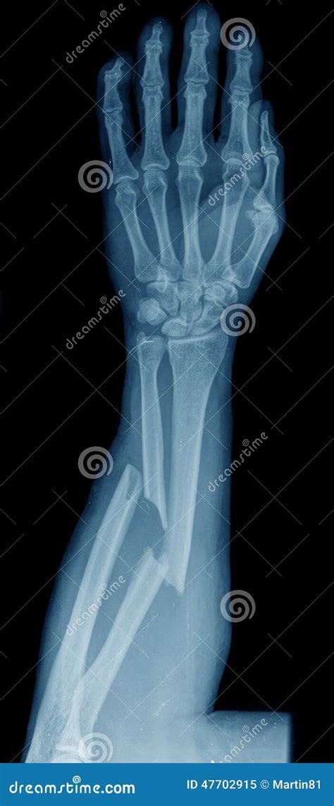 X-ray Of Broken Arm Stock Photo - Image: 47702915