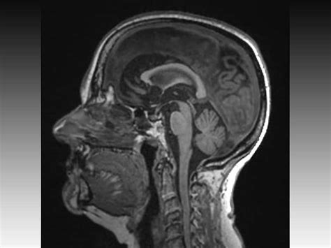 Novel Protein Signals Rapid Hippocampal Atrophy in AD