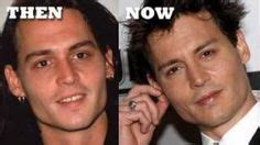 Johnny Depp hair transplant before and after (With images) | Plastic surgery, Cosmetic surgery ...