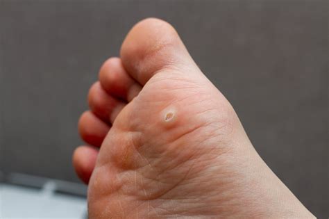 Plantar Warts in Adults & Children — Causes, Treatment, and Prevention | Arizona Foot Doctors