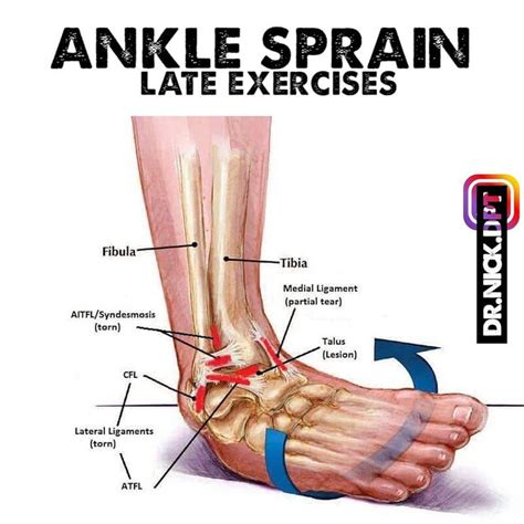 [ LATE PHASE ANKLE SPRAIN ] --- Ankle sprains are an extremely common occurrence. They can vary ...