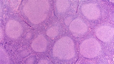 Lymphoma Action | Types of lymphoma