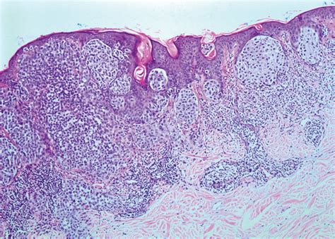 Malignant Melanoma Histology