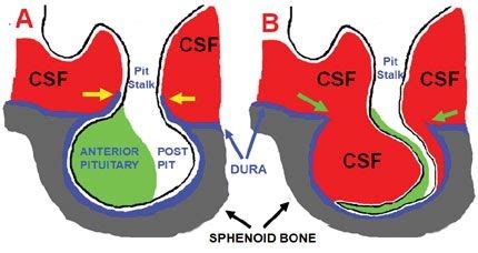 Empty sella syndrome | You and Your Hormones from the Society for ...