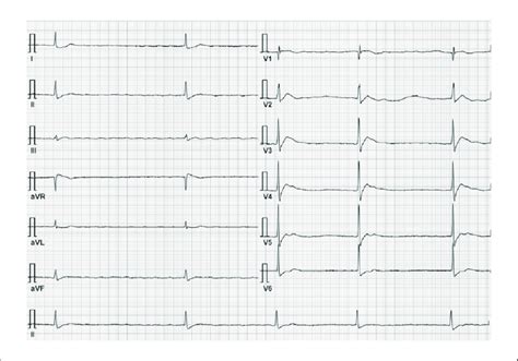 Ventricular Fibrillation