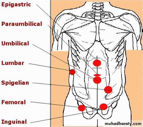 Male Abdominal Hernia Pictures : Inguinal Hernias: Types, Causes & Treatments for Baton Rouge ...