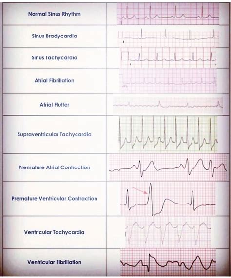 Pinterest | Ekg interpretation cheat sheets, Ekg interpretation, Ekg