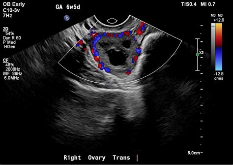 Corpus Luteum Ultrasound