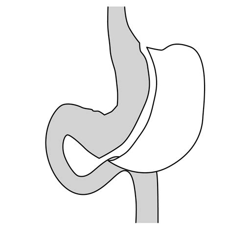 Sleeve Gastrectomy Diagram