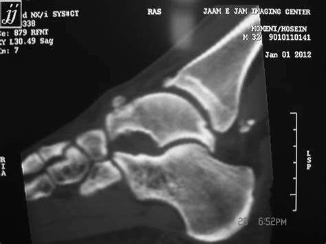 MSK- subchondral bone defect of talus and posterior tibia talar loose bodies and dorsal talar ...