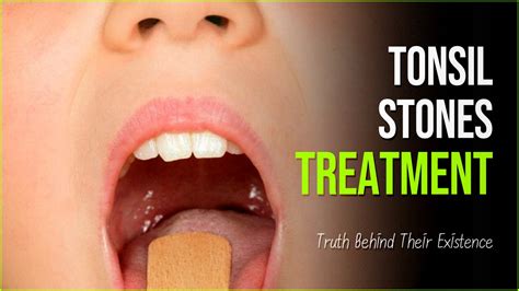 Tonsil Stones: The Truth Behind Their Existence And How To Treat Them