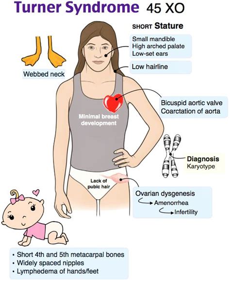 Turner Syndrome | Turner syndrome, Medical surgical nursing, Nursing school survival