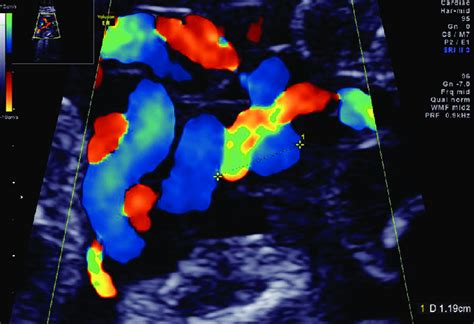 The ultrasonography findings of a hyper-coiled umbilical cord in case 1. | Download Scientific ...