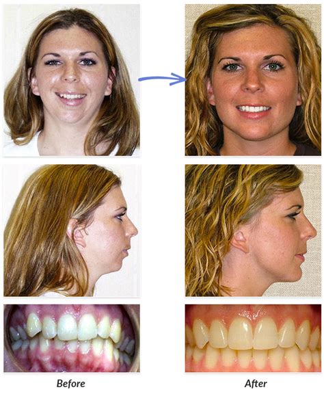 Before & After Braces Photos | DeLurgio Orthodontics : DeLurgio Orthodontics