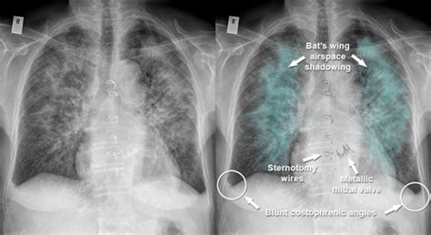 chest x ray terminology Flashcards | Quizlet