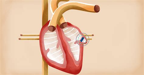 Watchman procedure reduces stroke risk in AFib patients