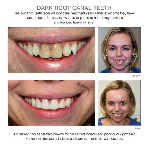 Pin en Porcelain Veneers Before and After