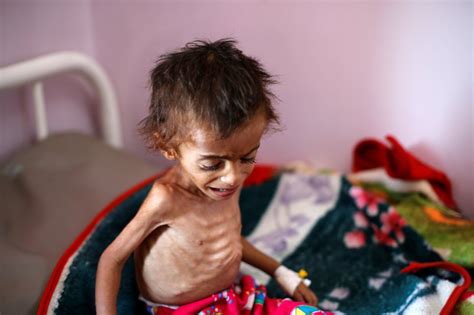 Yemen on verge of worst famine in 100 years as civil war rages on | Metro News