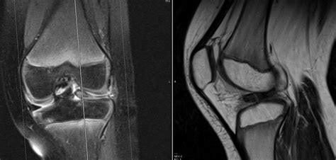 Management of a Lateral Meniscus Tear with Bucket-Handle Displacement ...