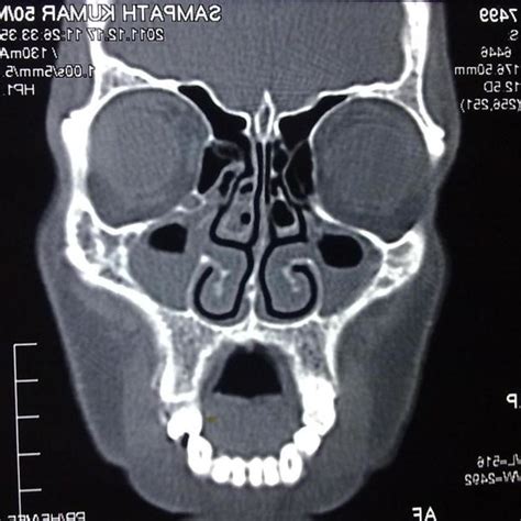 CT scan of a patient showing paradoxical middle turbinates | Download ...