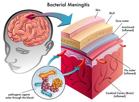 Bacterial Meningitis : Overview, Causes, Symptoms, Treatment - illness.com