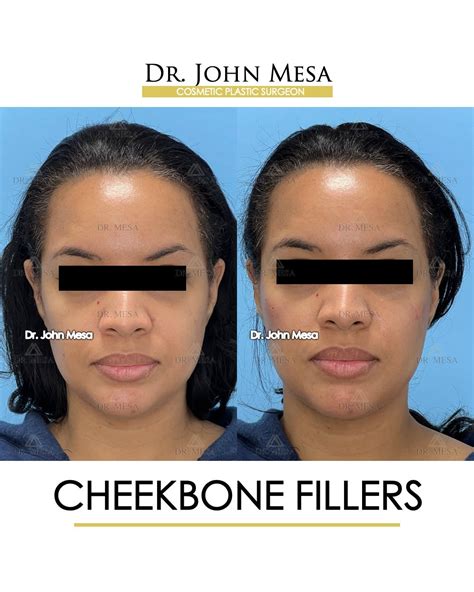 Cheekbone Filler Before & After Photos | Dr. Mesa