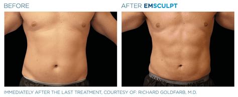 Emsculpt NEO Before and After Pictures - Cunningham Clinic