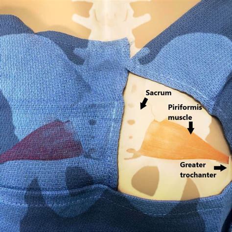 Piriformis Injection Landmarks