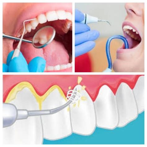 Limpieza dental y blanqueamiento no es lo mismo - Clínica Dental Oliver Coll