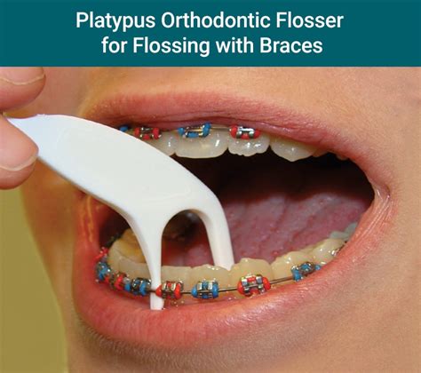 How to Floss With Braces - Gibbs Orthodontic Associates