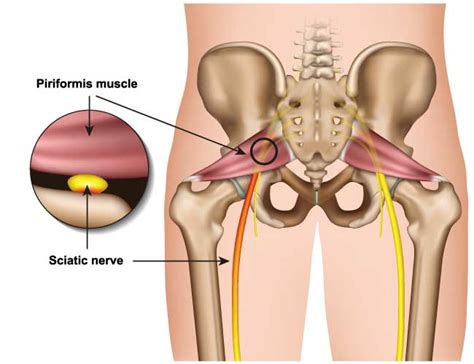 Piriformis Syndrome | Altair Health