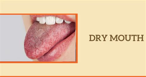 Dry Mouth (Xerostomia): Symptoms, Causes, Treatments