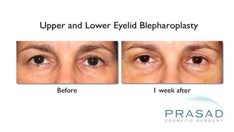 Upper Eyelid Surgery and Recovery | Eyelid Surgery in New York