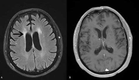 Cureus | Neurological Disorders Associated with Glutamic Acid Decarboxylase Antibodies