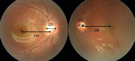 Ungsoo S. Kim: What is optic nerve hypoplasia